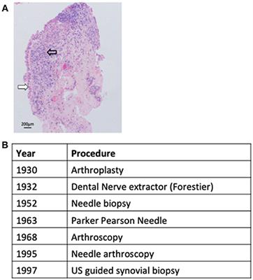 Synovial Tissue Sampling in Rheumatological Practice—Past Developments and Future Perspectives